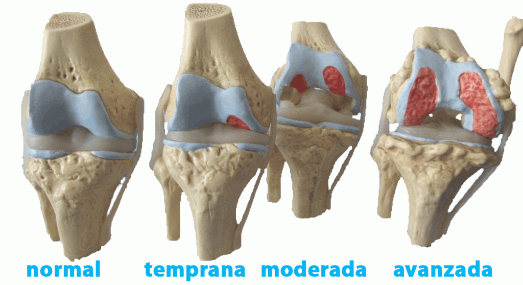 Artrosis en la rodilla Praxia Body Repair